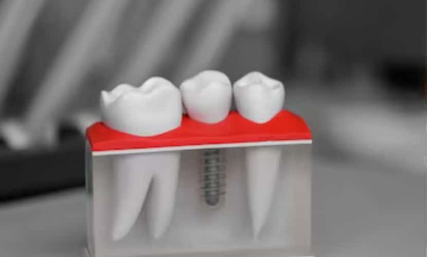 Dental Veneers Las Vegas, NV