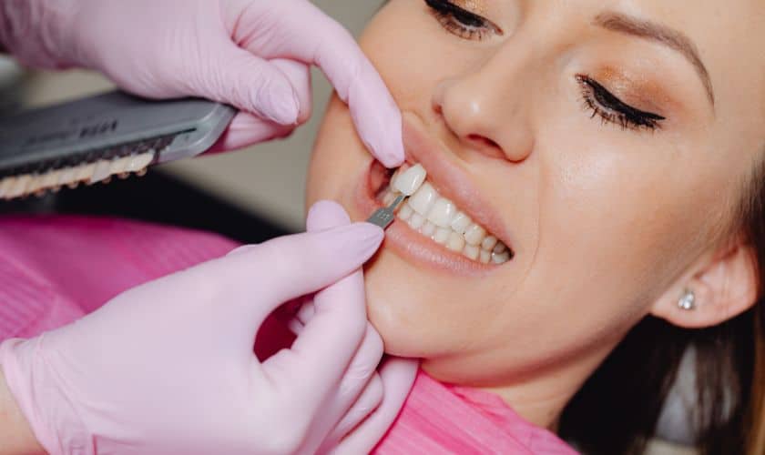 Veneers