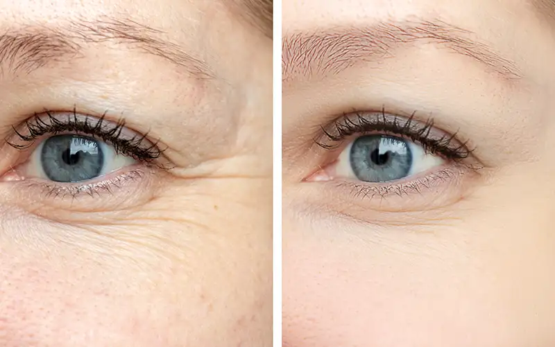Before and after close-up of eye area showing reduced wrinkles and smoother skin texture.