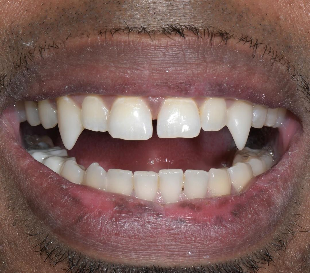 Close-up of open smile showing upper and lower teeth with dental work visible.