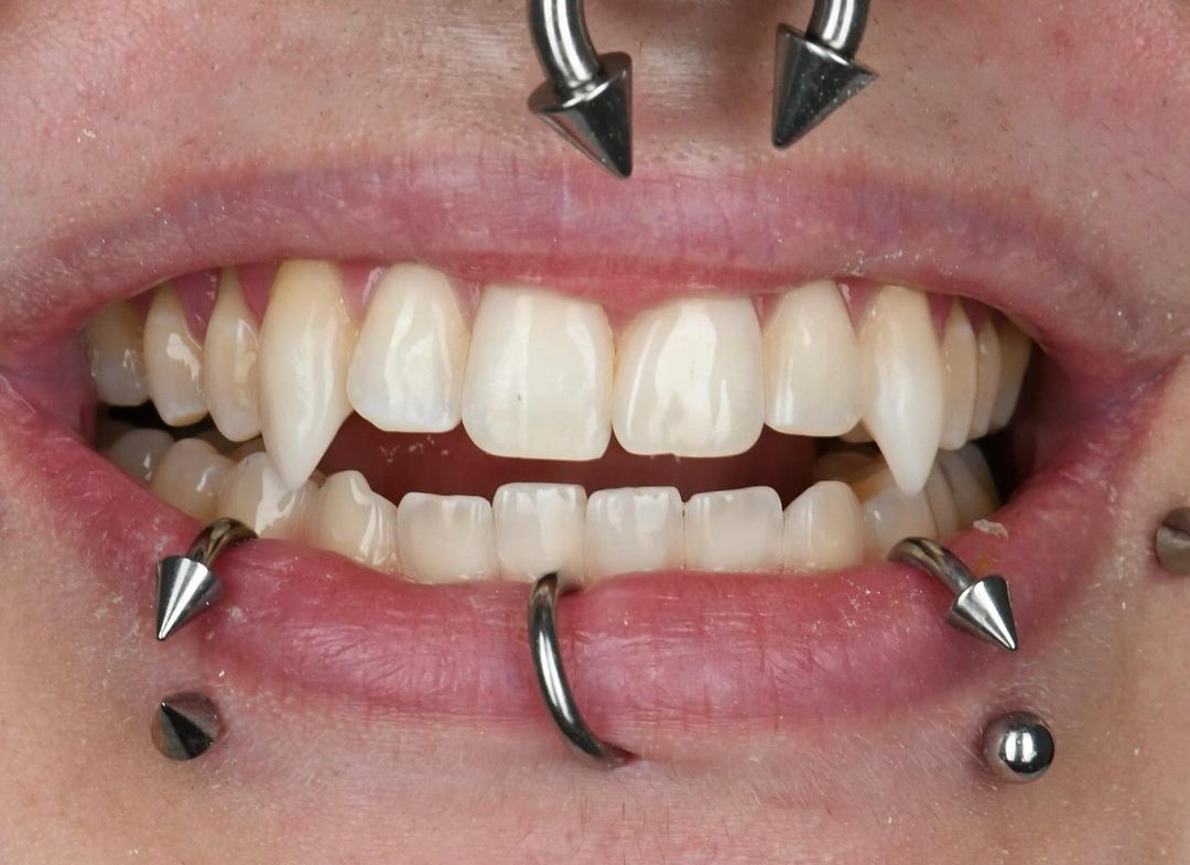 Close-up of smile displaying dental work with multiple facial piercings and metallic jewelry.