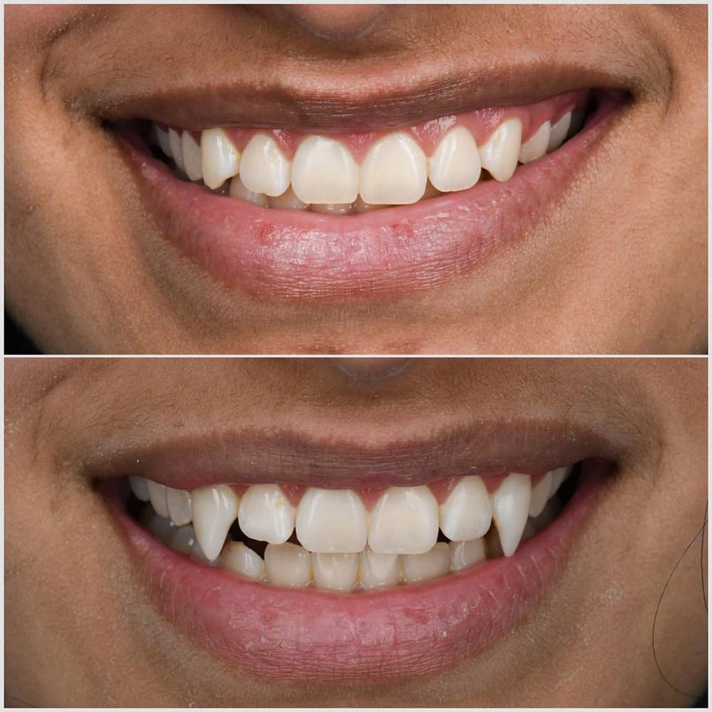 Before and after comparison of dental smile transformation showing improved tooth alignment and whiteness.