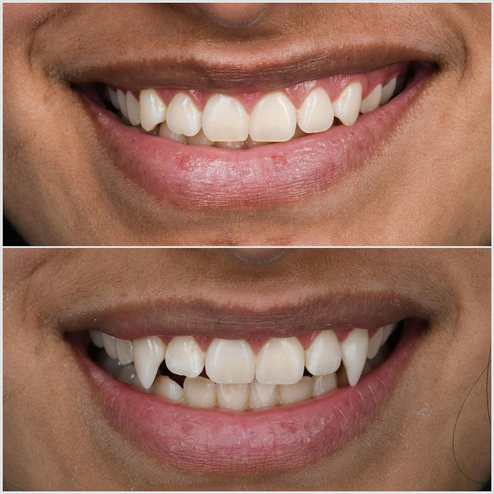 Before and after dental comparison showing smile improvement at Vegas Smile Suite dental practice.