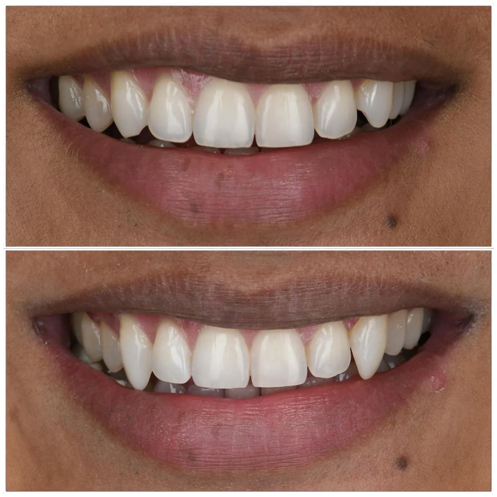 Before and after comparison of teeth whitening results from Vegas Smile Suite dental treatment.