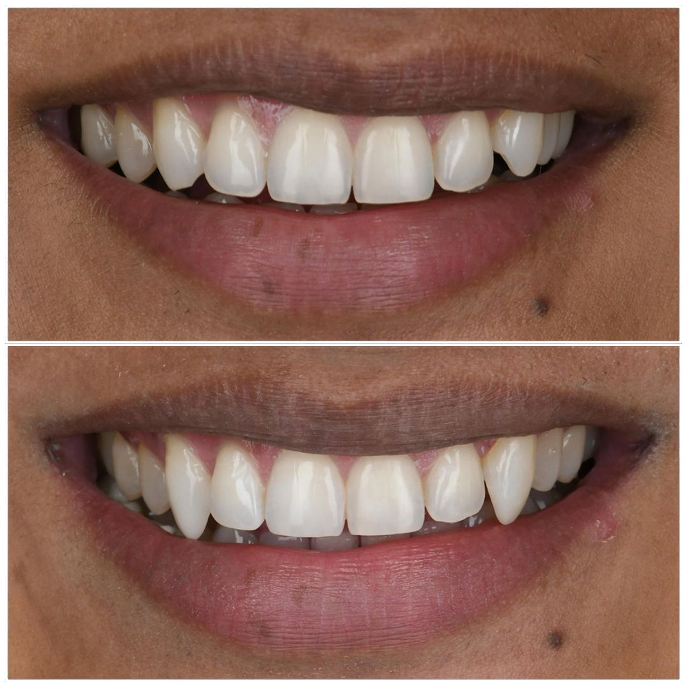 Before and after comparison of teeth whitening results showing brighter, whiter smile transformation.