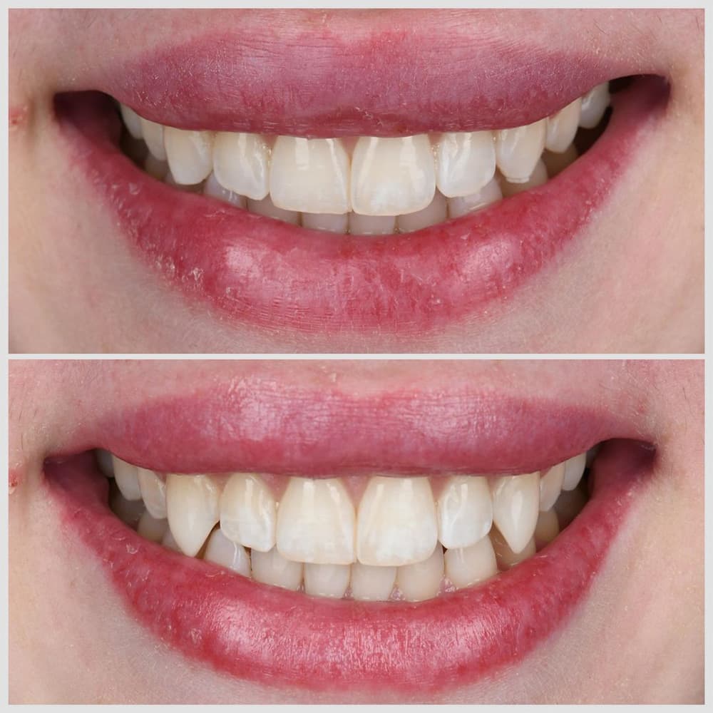 Before and after comparison of teeth whitening results showing brighter, whiter teeth in lower image.