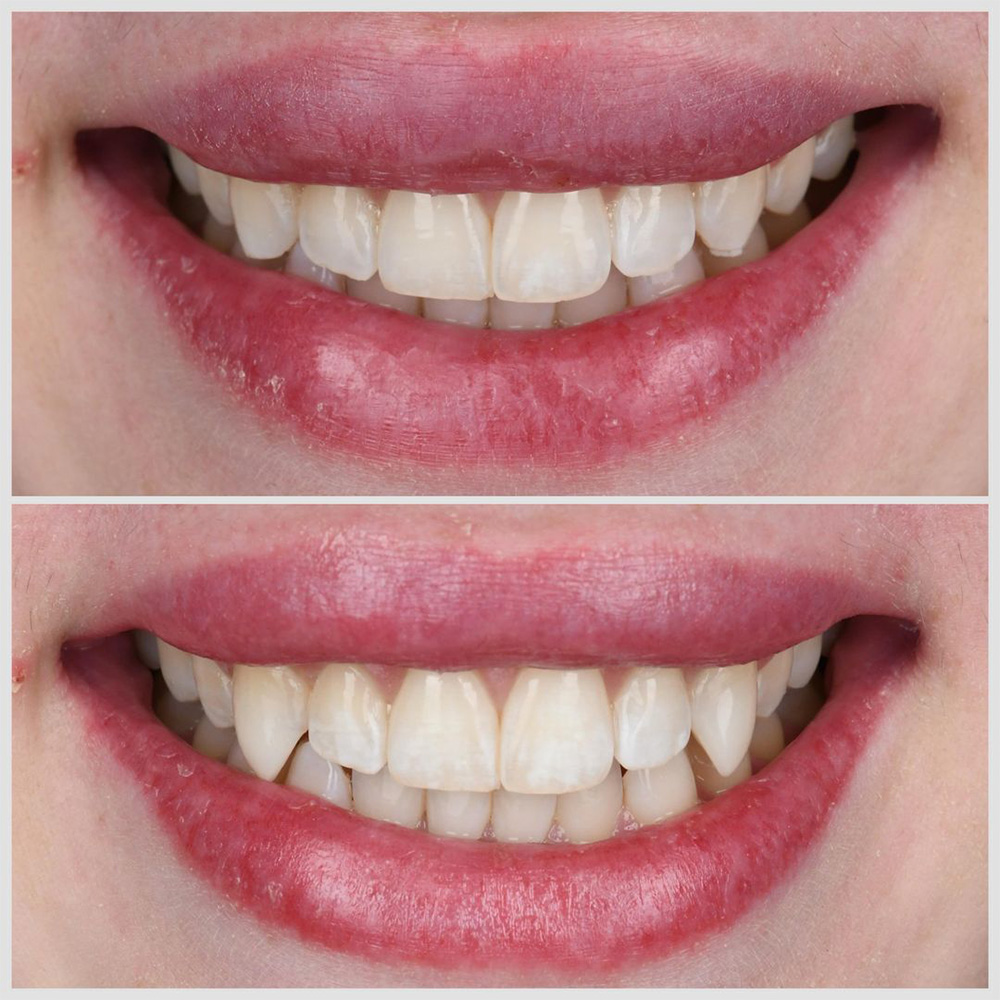 Before and after dental smile comparison showing teeth whitening results at Vegas Smile Suite.