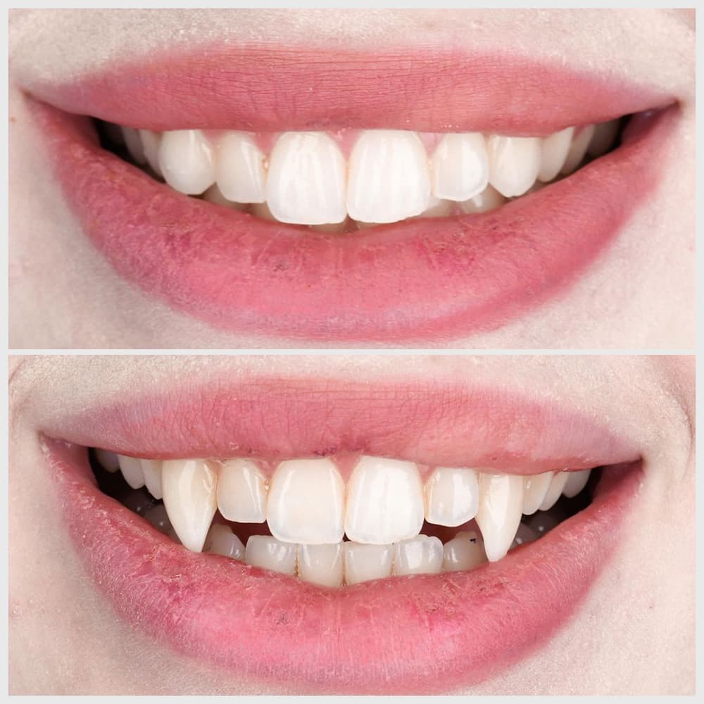 Before and after comparison of dental veneers showing improved tooth alignment and appearance.