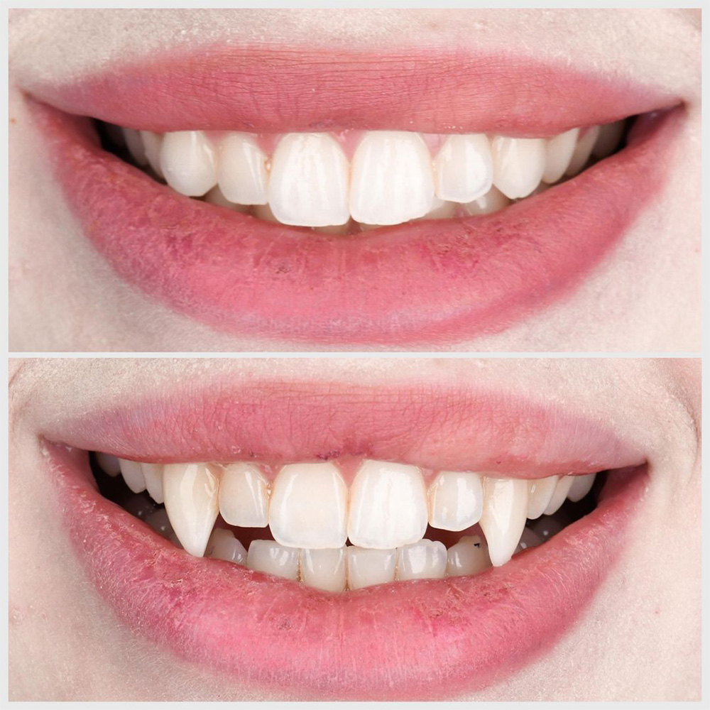 Before and after comparison of vampire fang dental veneers showing normal teeth versus pointed canine teeth.